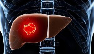 Clonorchis sinensis: Liver Fluke in Humans